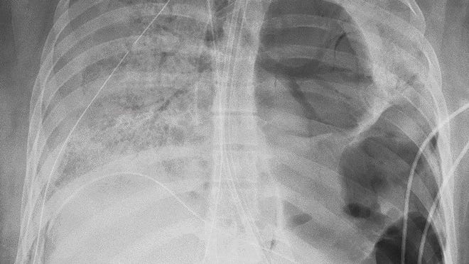 An X-ray shows the chest of a COVID-19 patient before she received a new set of lungs at Northwestern Memorial Hospital in Chicago. The virus had severely damaged her lungs.